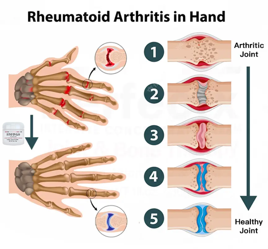 FlexiRelief™ - Gewrichts- en Bottherapiecrème