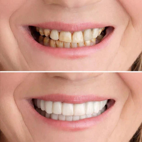 SmileFix™ Für perfekte Zähne | NUR HEUTE 1 + 1 GRATIS