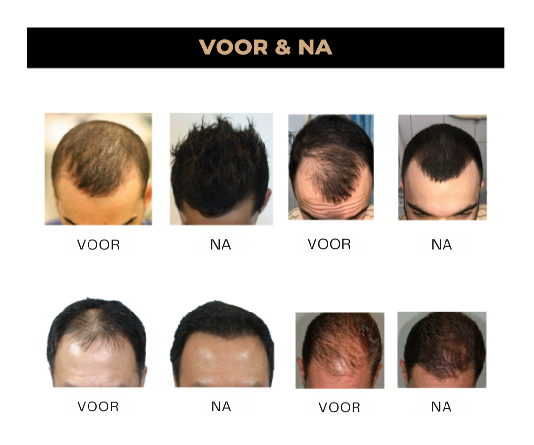 HairFix™ | Geen kale plekken meer!