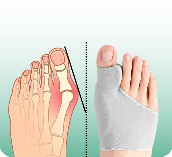 OrthoFix™ Hallux Correctie Kit